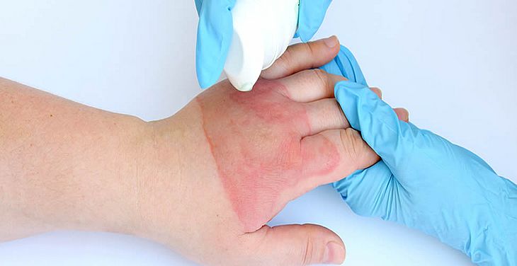 CUIDADO! - Uso errado do álcool para prevenir Covid-19 pode provocar queimaduras